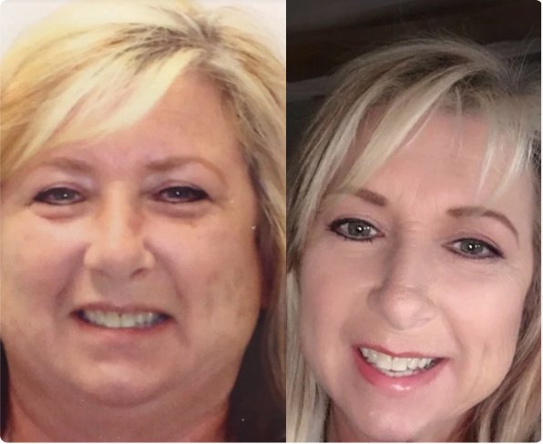 A before and after photo of West Texas Bariatrics patient Andrea Taylor