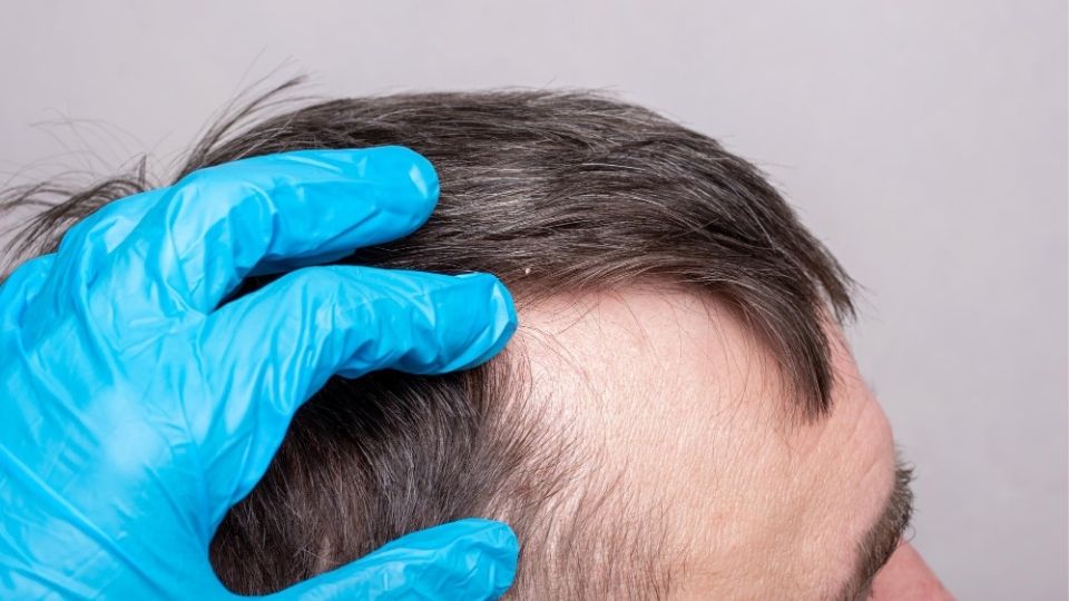هل يمكنني منع تساقط الشعر بعد جراحة السمنة؟