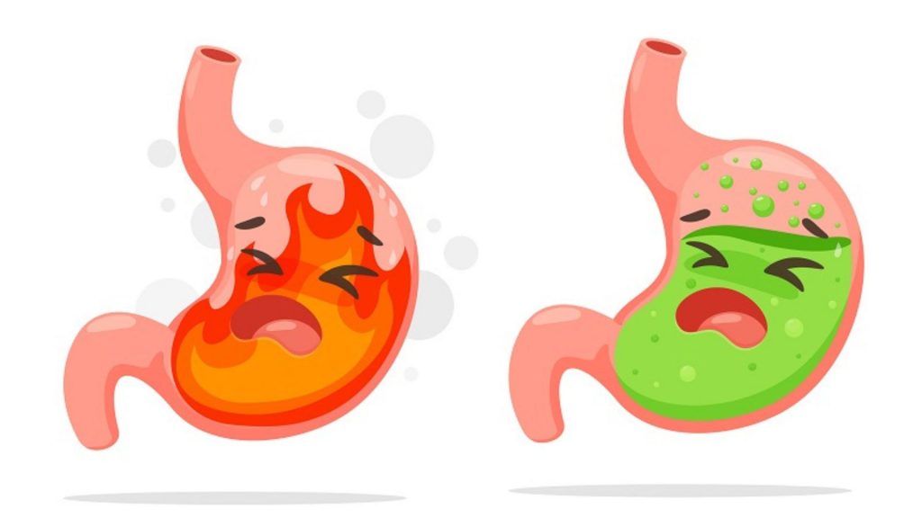 How Can I Fix My Acid Reflux After Gastric Sleeve Surgery?