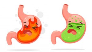 How Can I Fix My Acid Reflux After Gastric Sleeve Surgery?