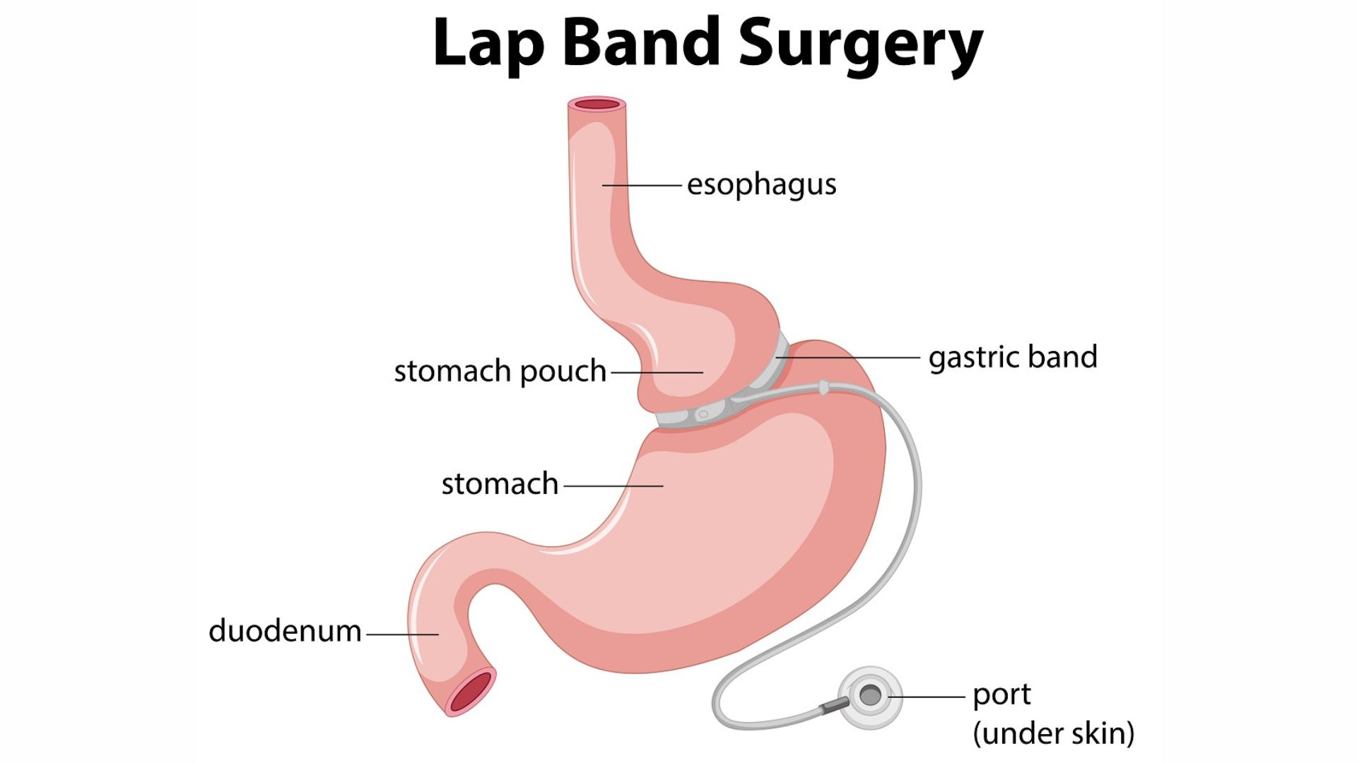 What to Expect After Lap-Band Surgery